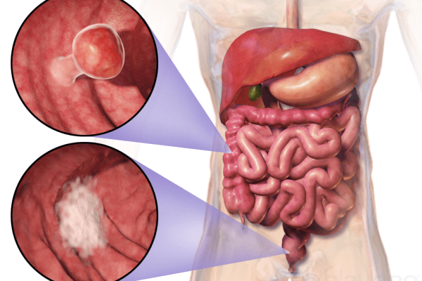 Adenocarcinoma